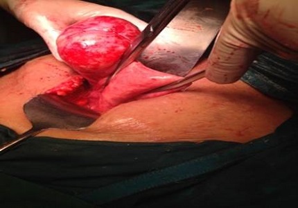 Malignancy in mature cystic teratoma of the ovary: A rarity