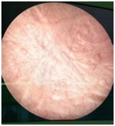 Hydro-dissection in a post hysterectomy female with dense labial fusion: a case report
