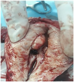 Correlation of Transvaginal USG and Endometrial aspiration findings with various menstruation patterns and histopathological examination of Uterus