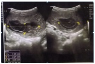 A case report of hydatidiform mole:A Diagnostic Dilemma